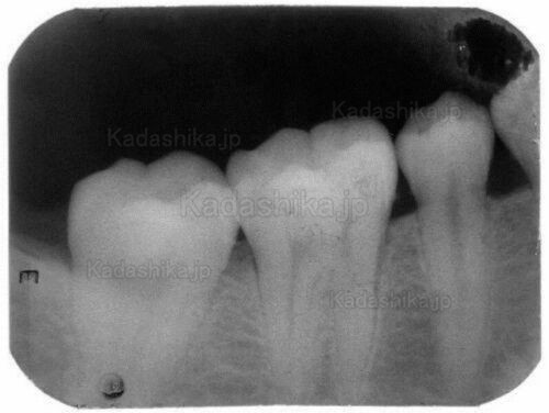 歯科ポータブル レントゲン デジタルレントゲン BLX-10